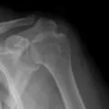 shoulder xray