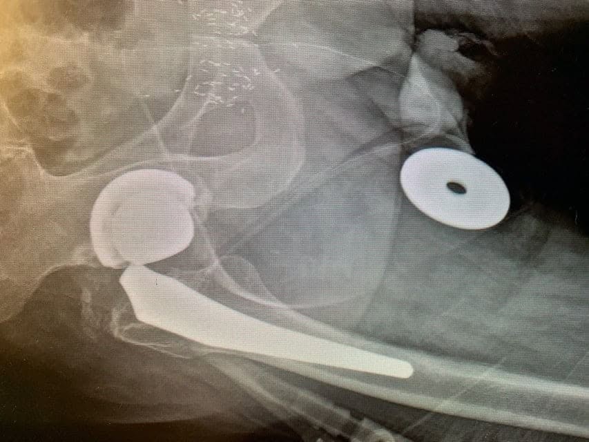 Case Study - Revision Hip 1a