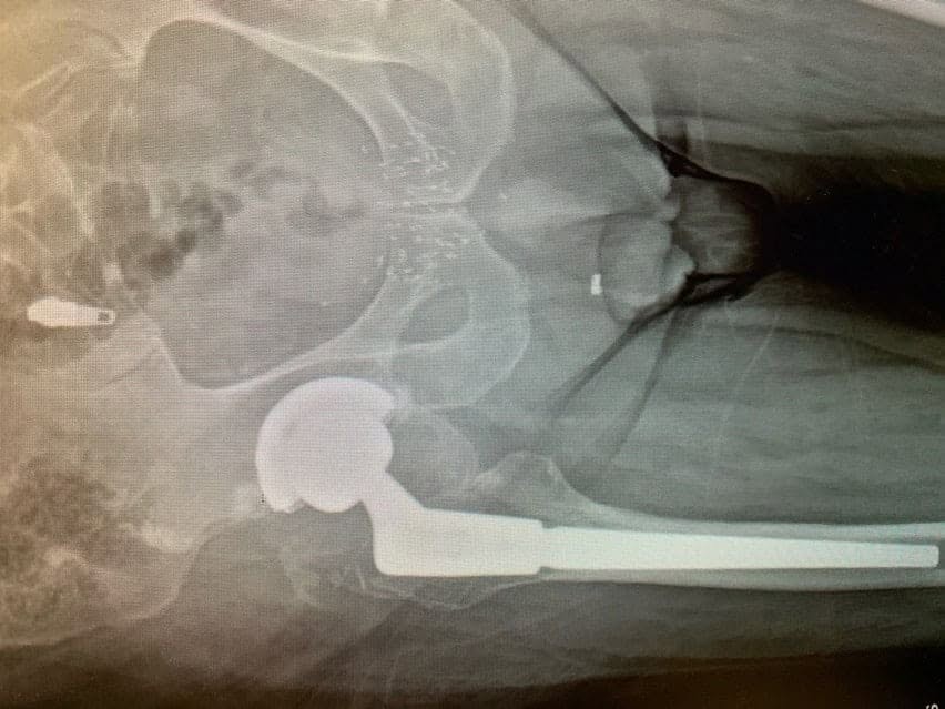 Case Study - Revision Hip 1b