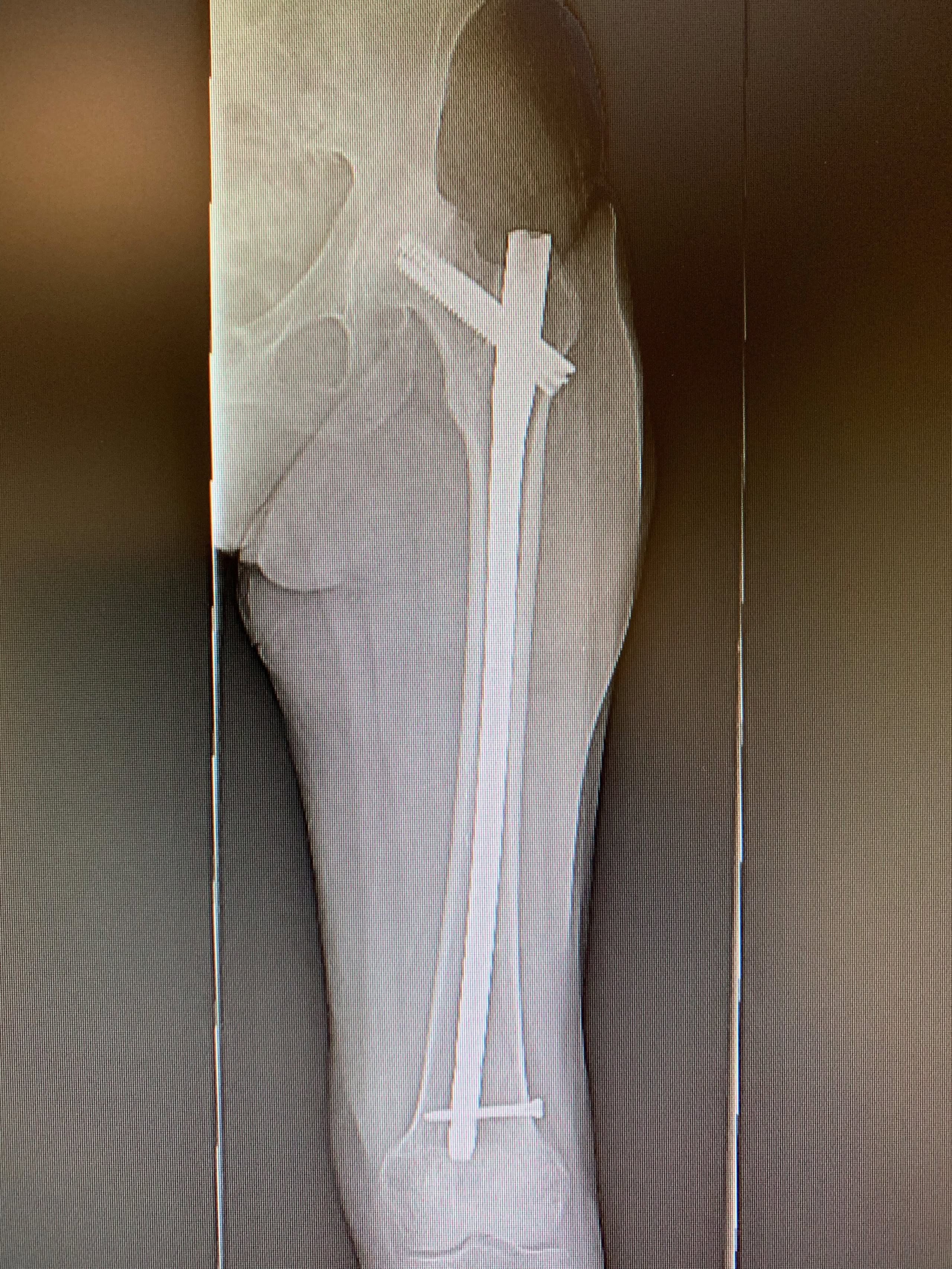 Reemplazo complejo de cadera - Reemplazo de cadera con hardware previo en posición en una mujer de 71 años