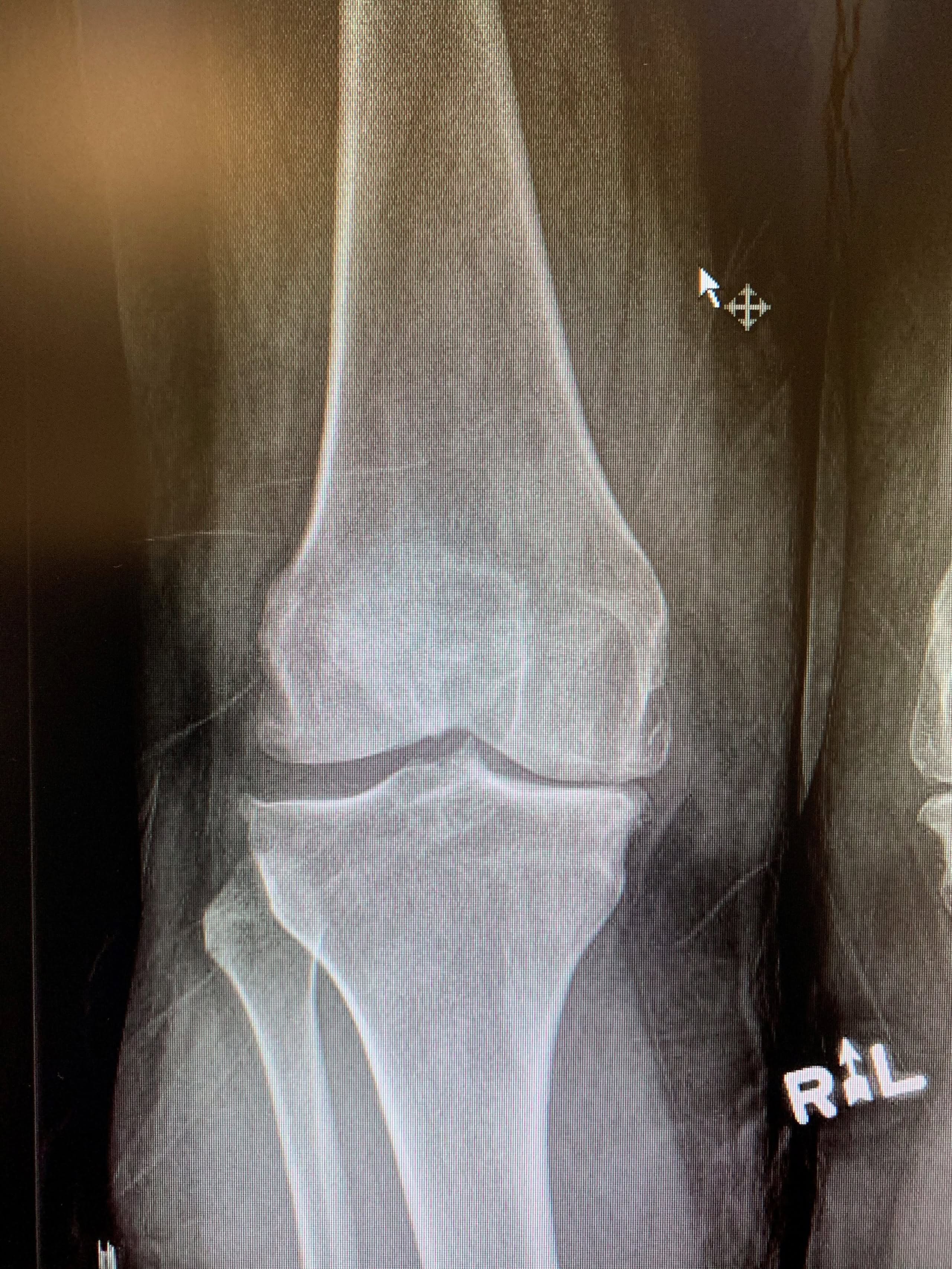 Primary Knee replacement with custom instrumentation in a 63 year old malea