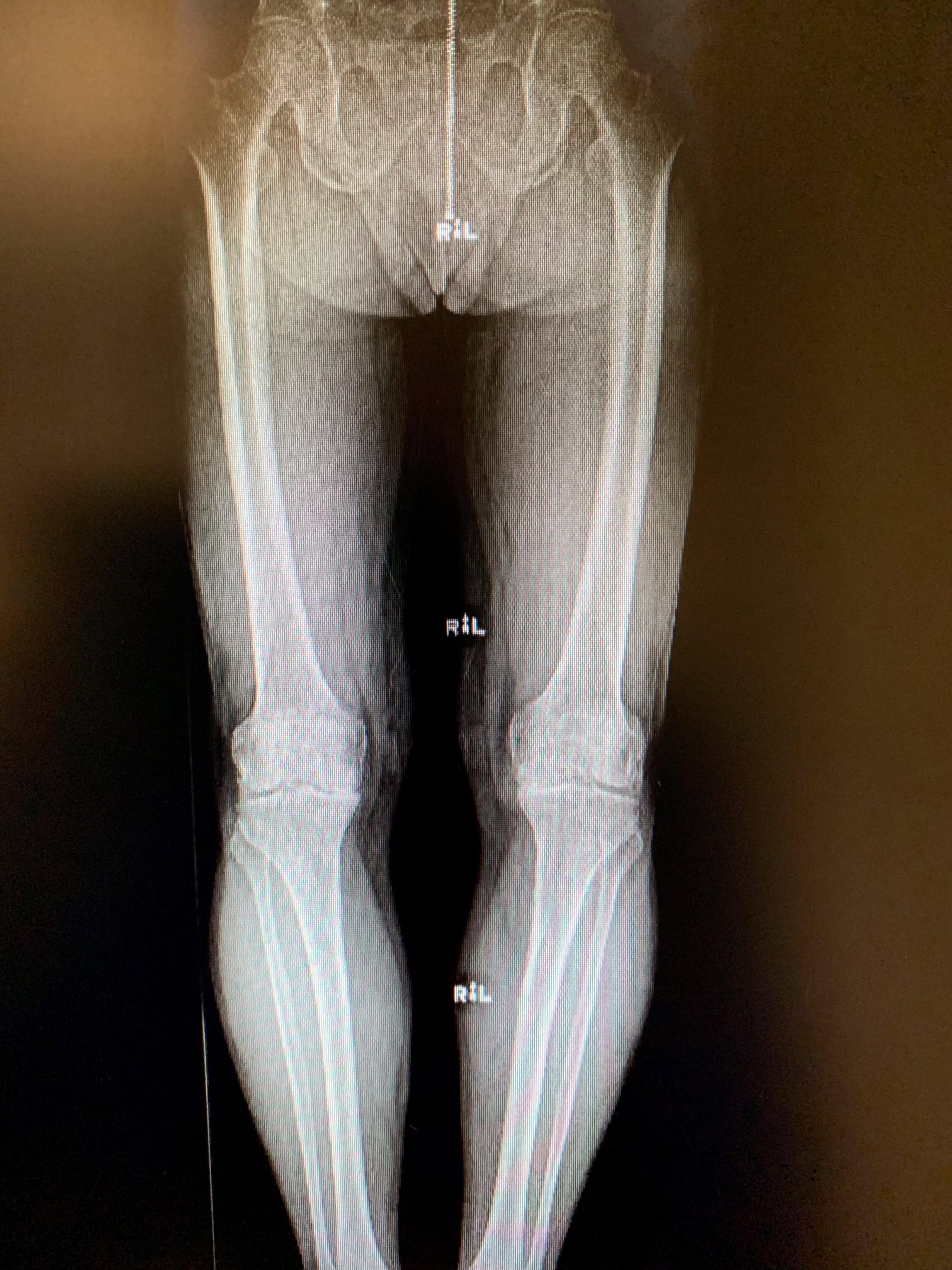 Reemplazo bilateral simultáneo de rodilla unicondílico en malea de 67 años