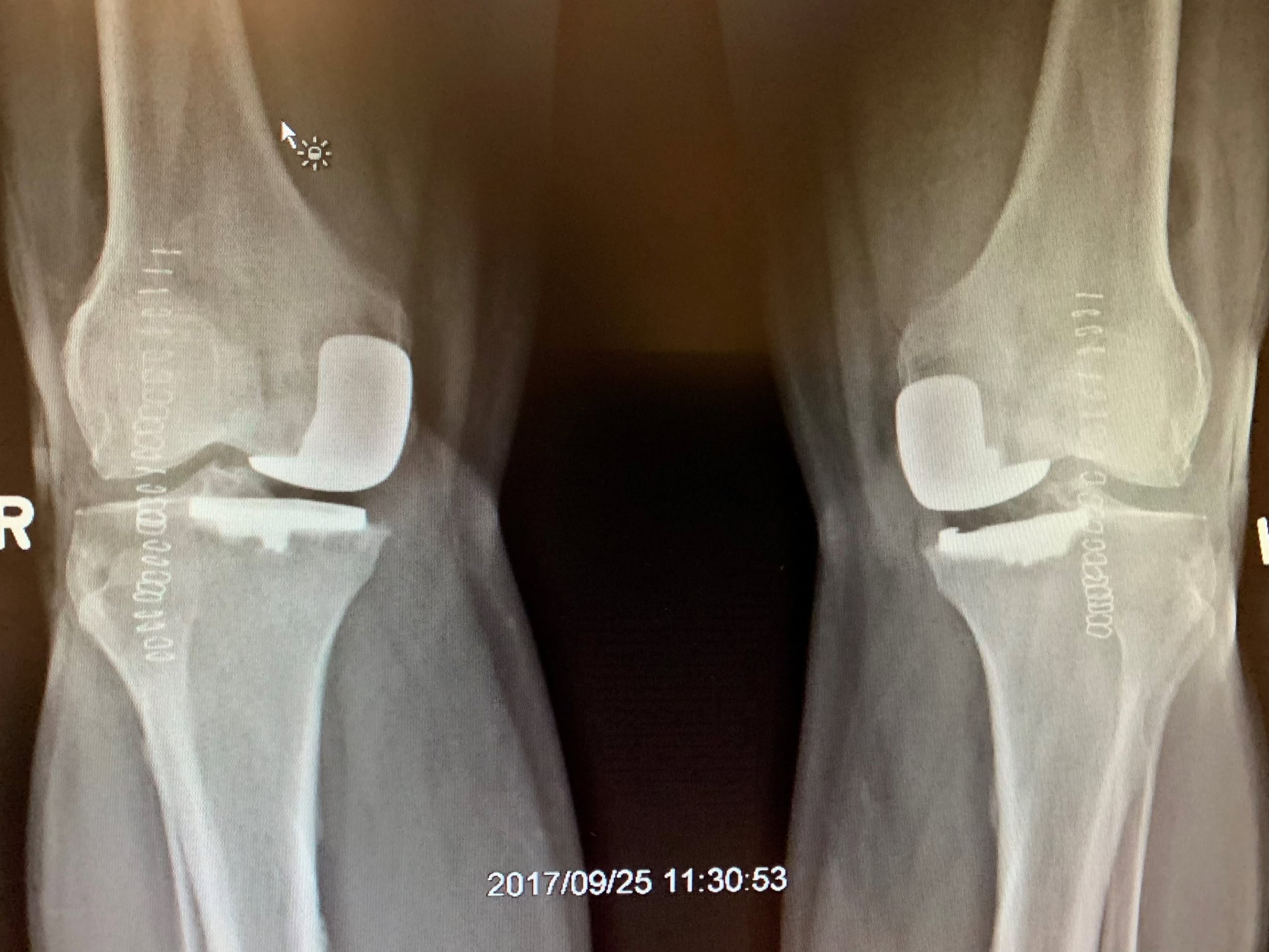Reemplazo bilateral simultáneo de rodilla unicondílar en un hombre masculino de 67 años