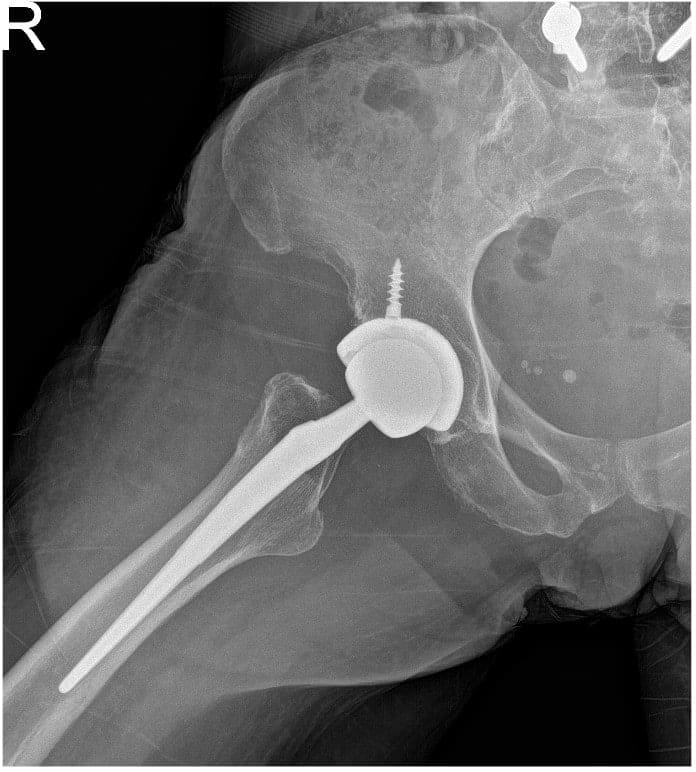 Radiografía postoperatoria de la cadera