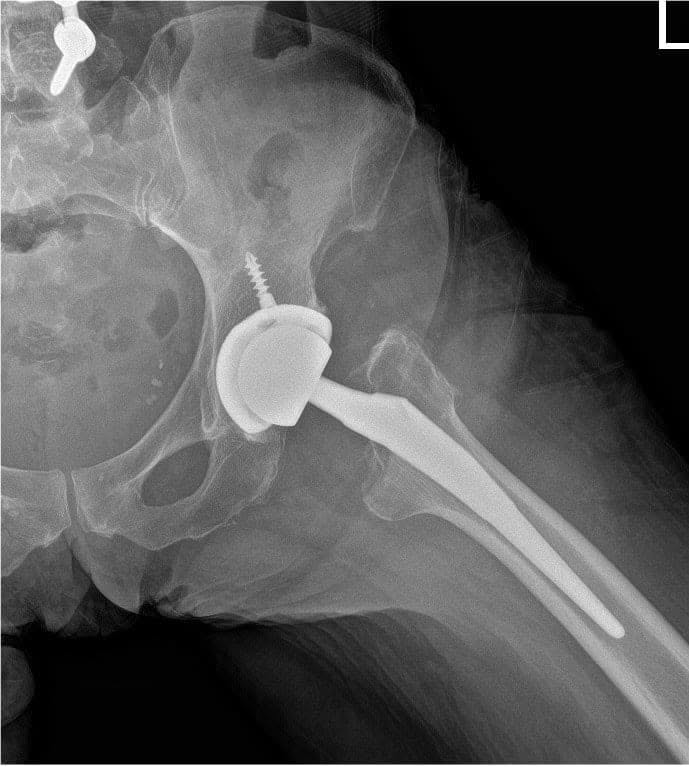 Radiografía postoperatoria de la cadera