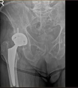 Radiografía de una prótesis de cadera