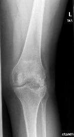 Radiografía que muestra las vistas AP y laterales de la rodilla izquierda tras la extirpación de la placa lateral de la meseta