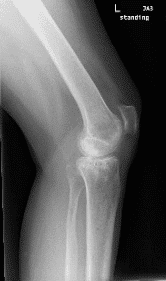 Radiografía de una rodilla izquierda