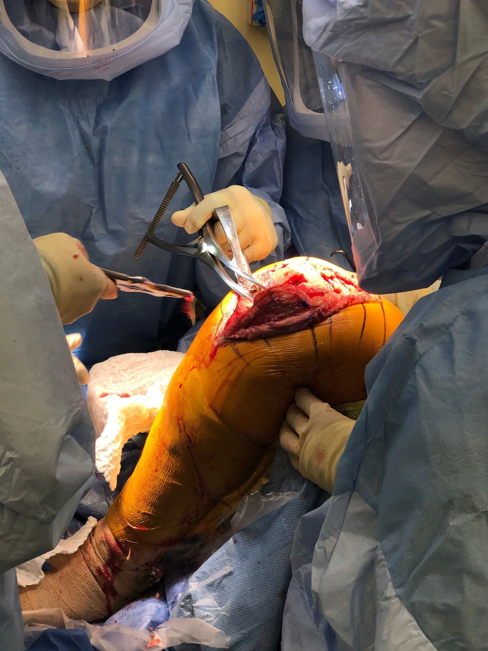 Cirujanos ortopédicos completos en quirófano trabajando en una rodilla