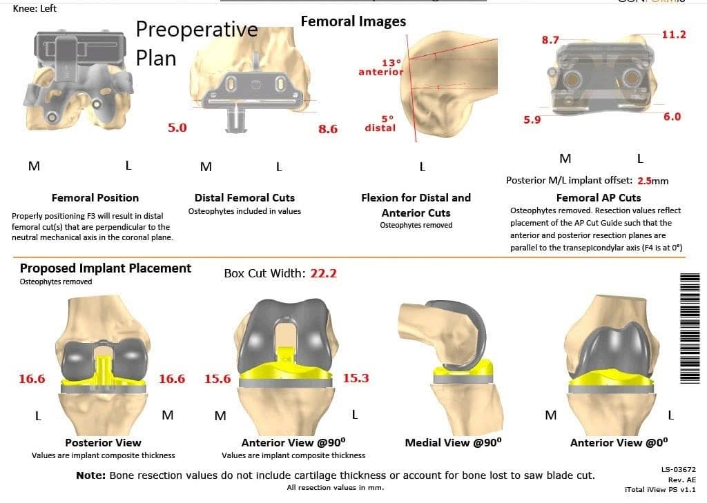 A patient specific surgical plan for a patient at Complete Orthopedics in New York - scan 4