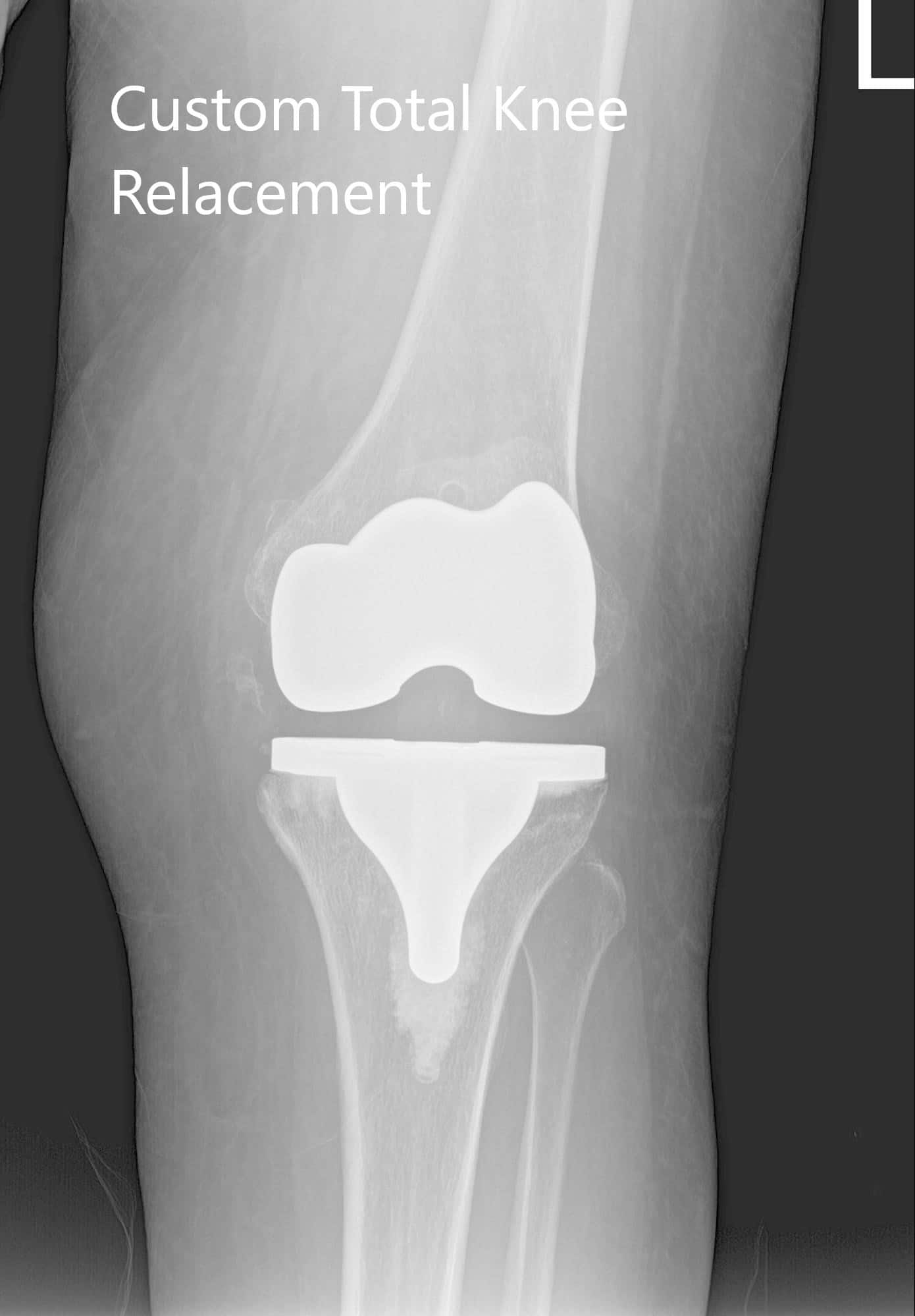 Radiografía postoperatoria que muestra vistas AP y laterales de la articulación derecha e izquierda de la rodilla