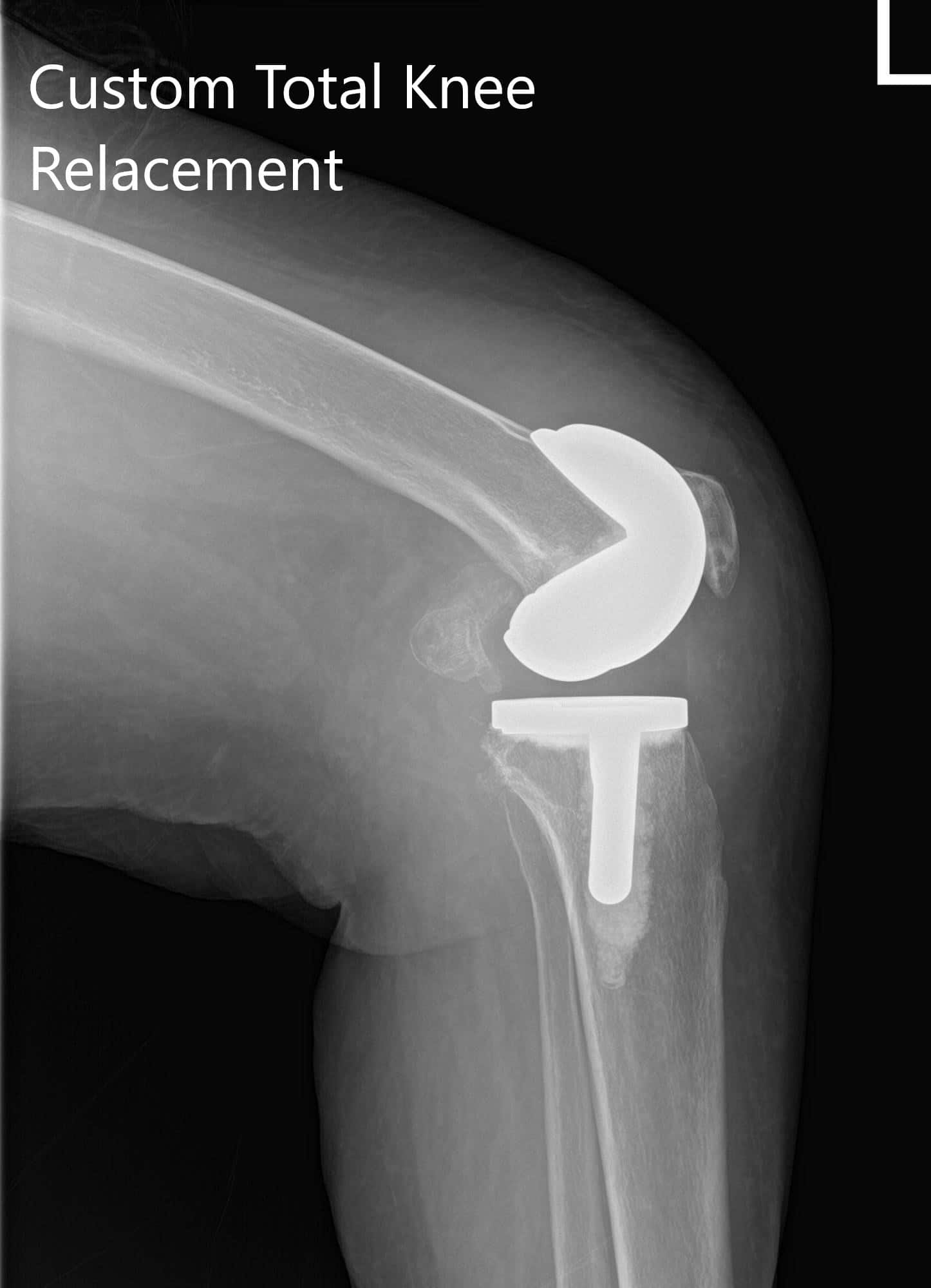 Radiografía postoperatoria que muestra vistas AP y laterales de la articulación derecha e izquierda de la rodilla - IMG 2