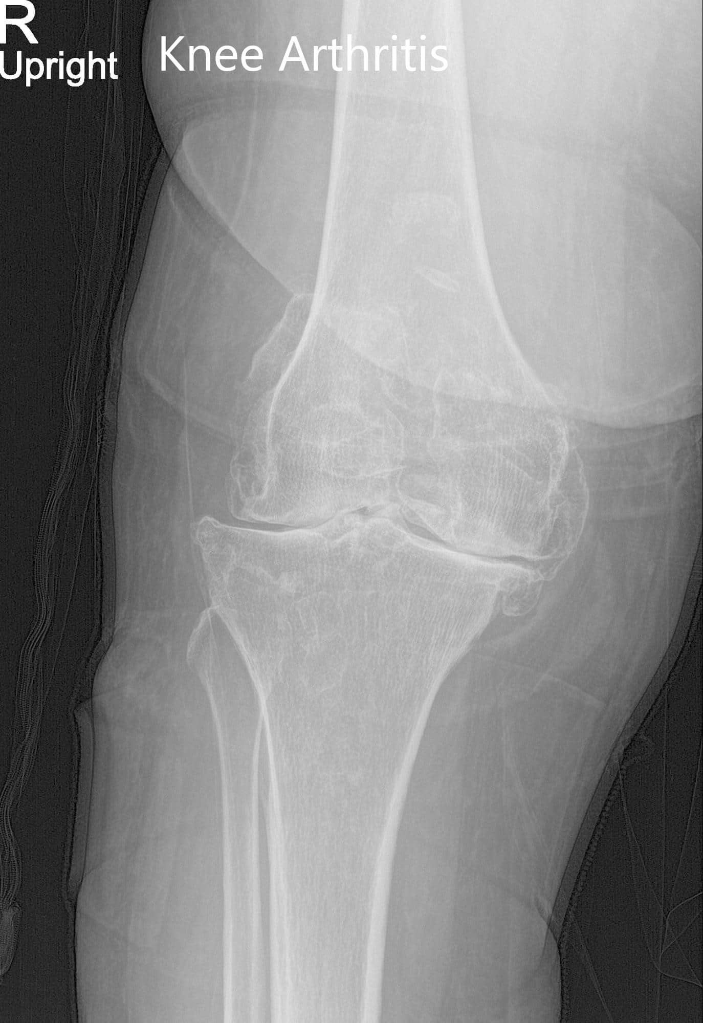 Radiografía preoperatoria de la rodilla derecha que mostró vistas AP y laterales