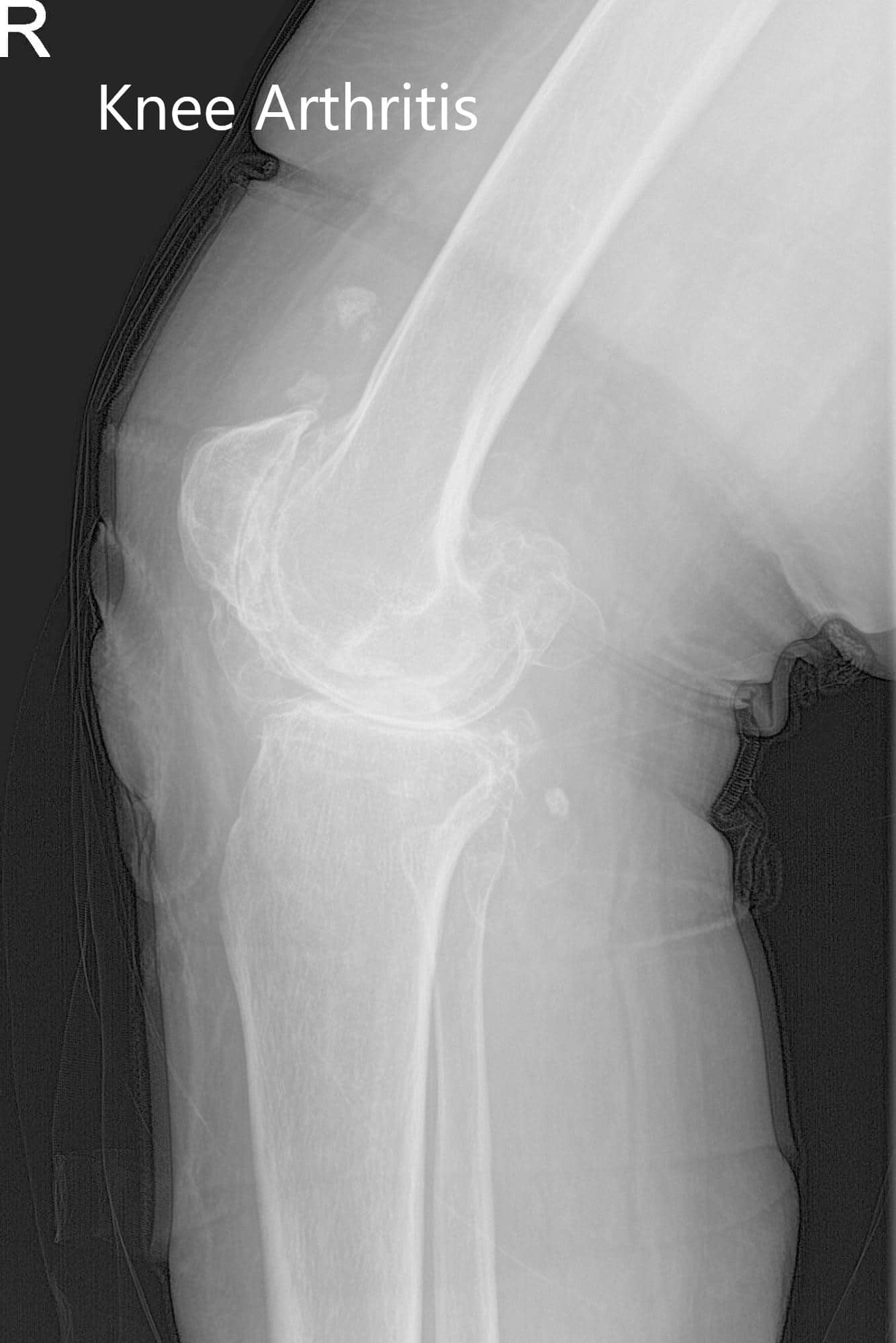 Preoperative X-ray of the right knee showing AP and lateral views - img 2