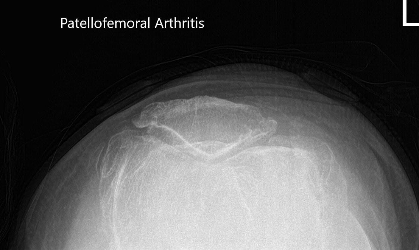 Vistas preoperatorias de la rótula bilateral que muestran osteoartritis severa del compartimento patelofemoral