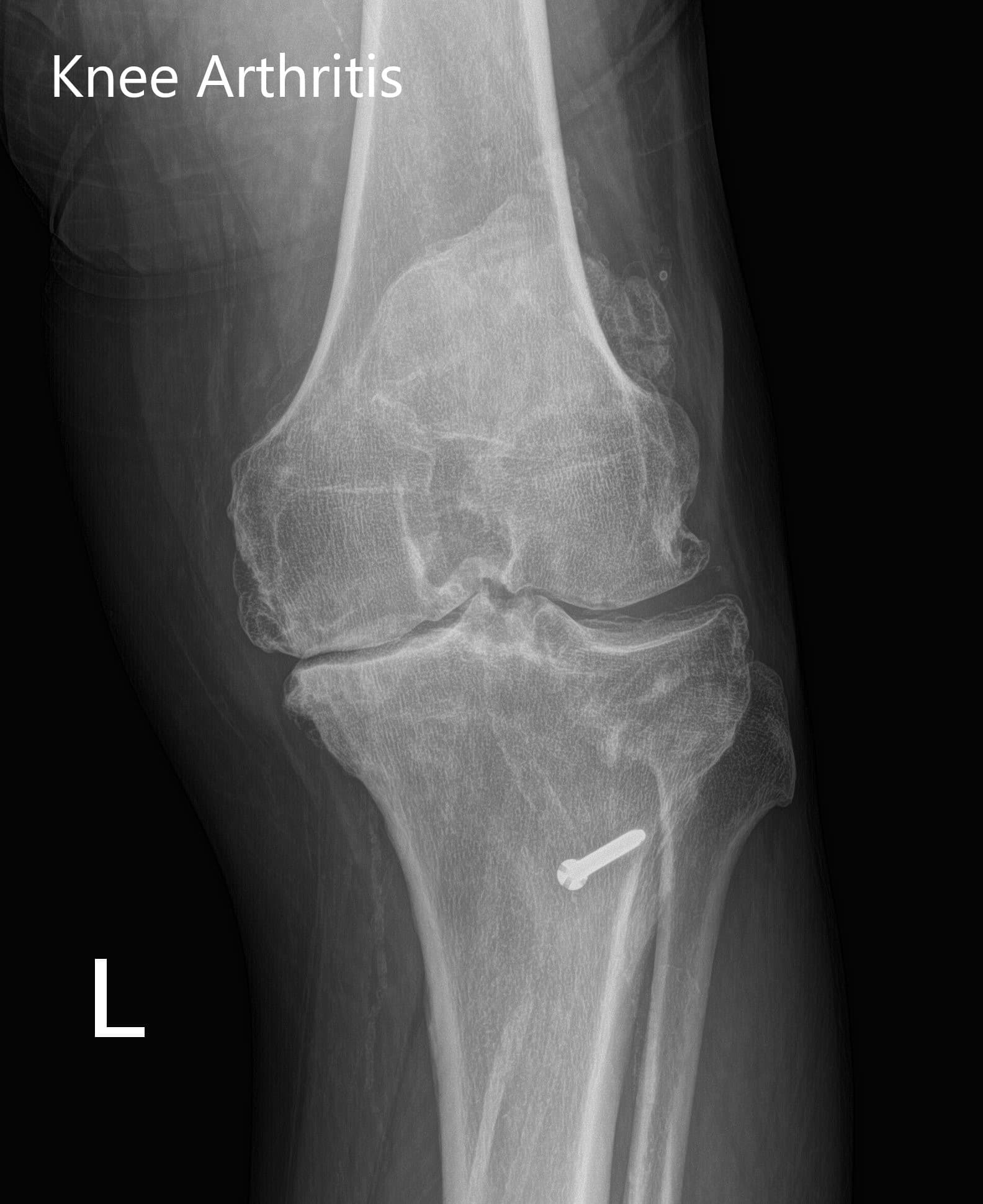 Preoperative X-ray of the left knee showing AP and lateral views with degenerative osteoarthritic changes and retained hardware in the proximal tibia