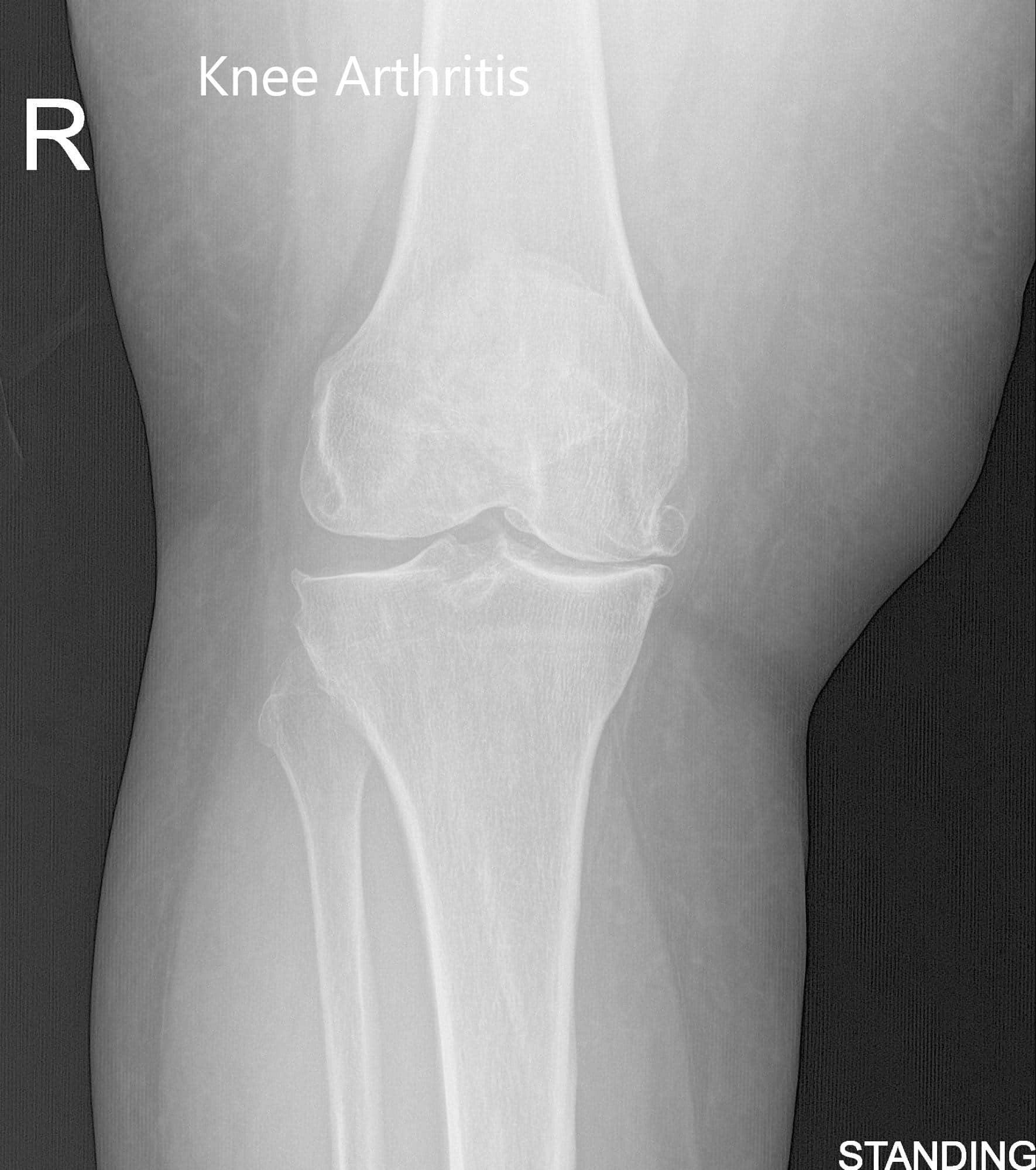 Vistas preoperatorias de la rodilla derecha con AP y radiografía lateral