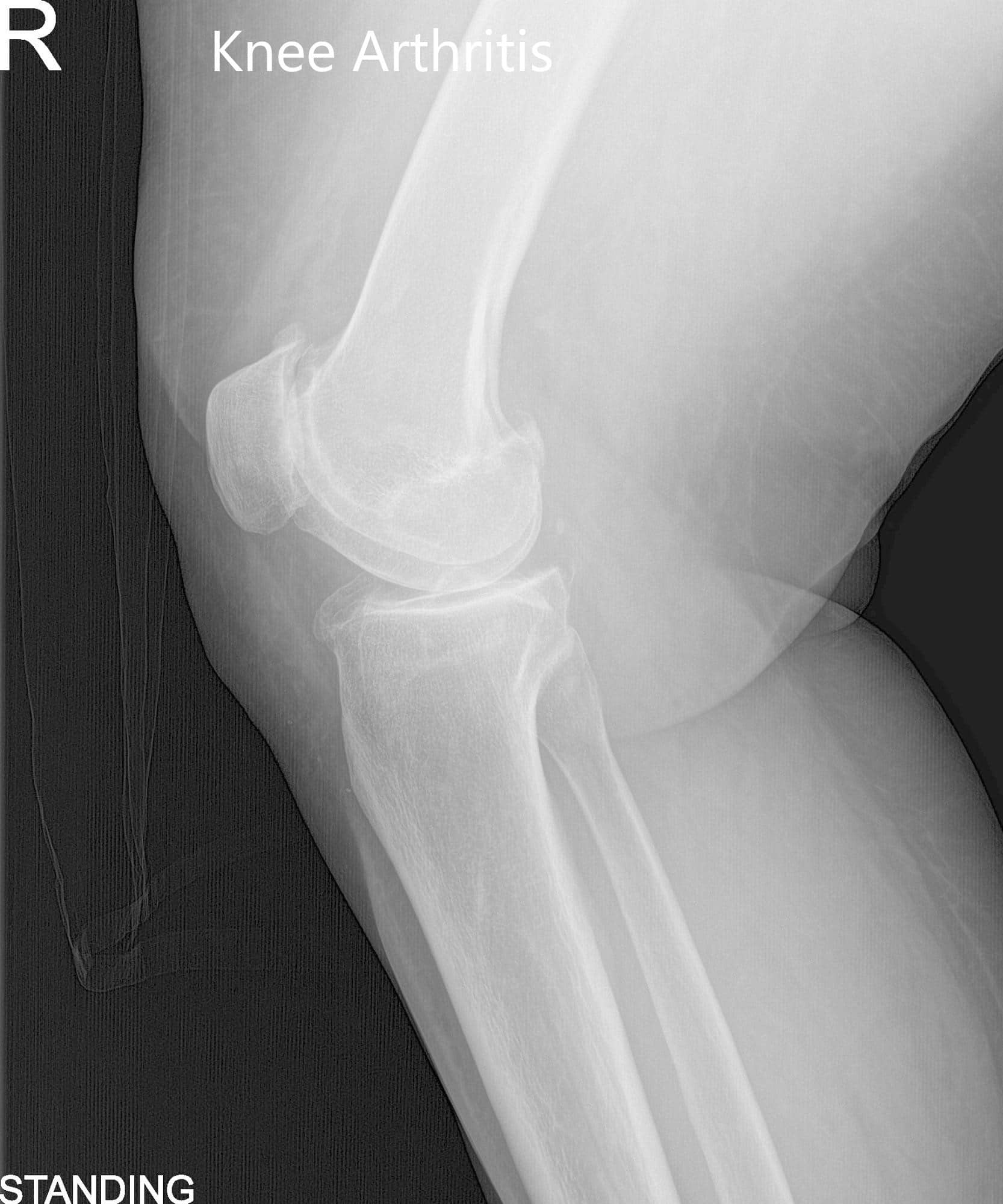 Vistas preoperatorias de la rodilla derecha con AP y radiografía lateral - img 2
