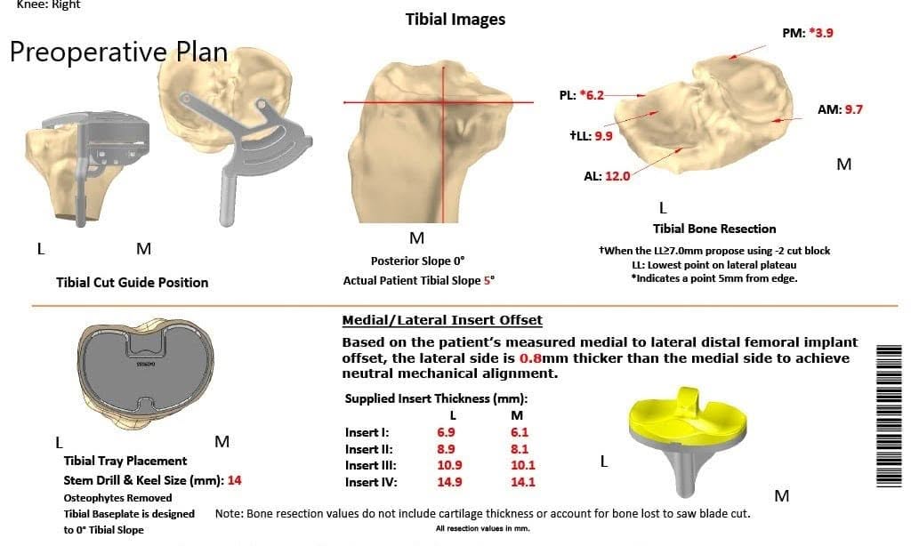 Plan quirúrgico completo específico para pacientes en ortopedia para un reemplazo unilateral de rodilla personalizado en una mujer de 74 años