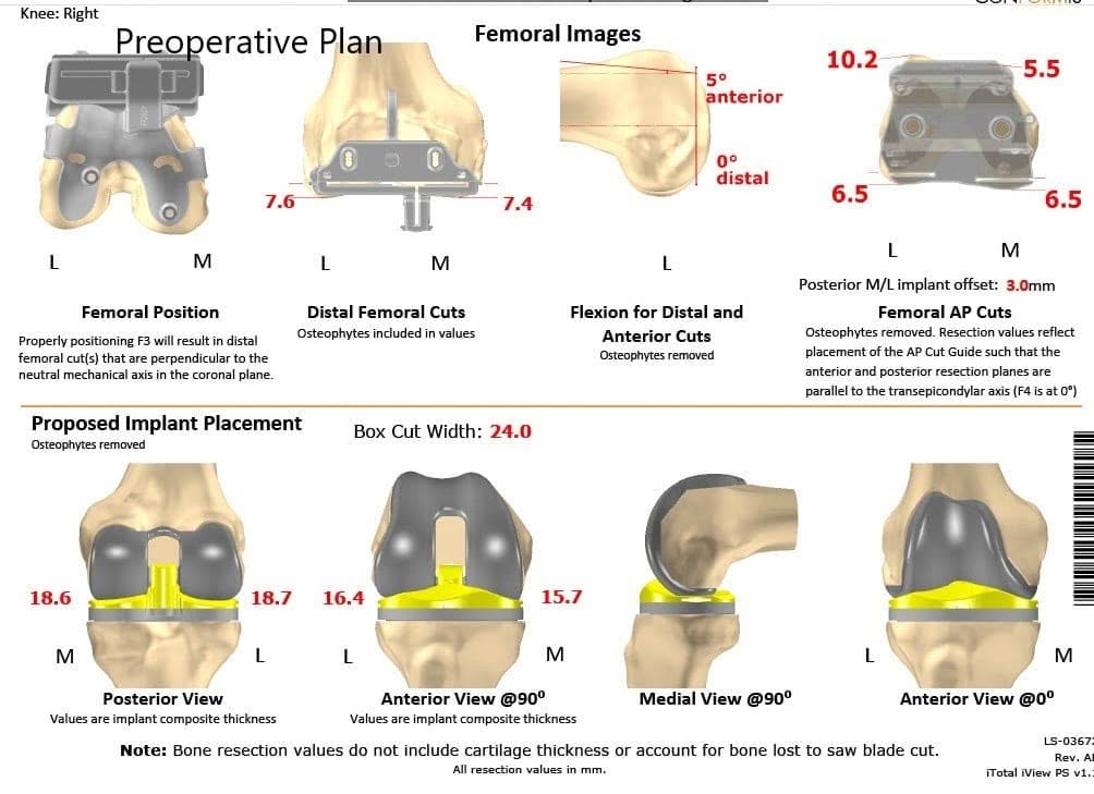 Plan quirúrgico completo de ortopedia específico para un reemplazo unilateral de rodilla personalizado en una mujer de 74 años - ecografía 2