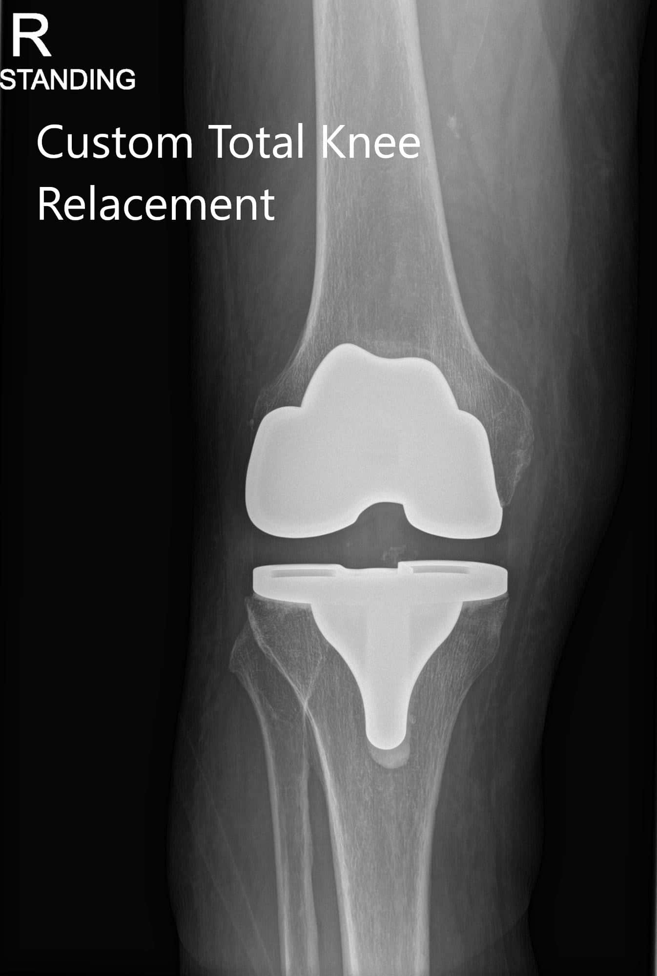 Radiografía postoperatoria de la rodilla derecha del paciente mostrando PA y vistas laterales