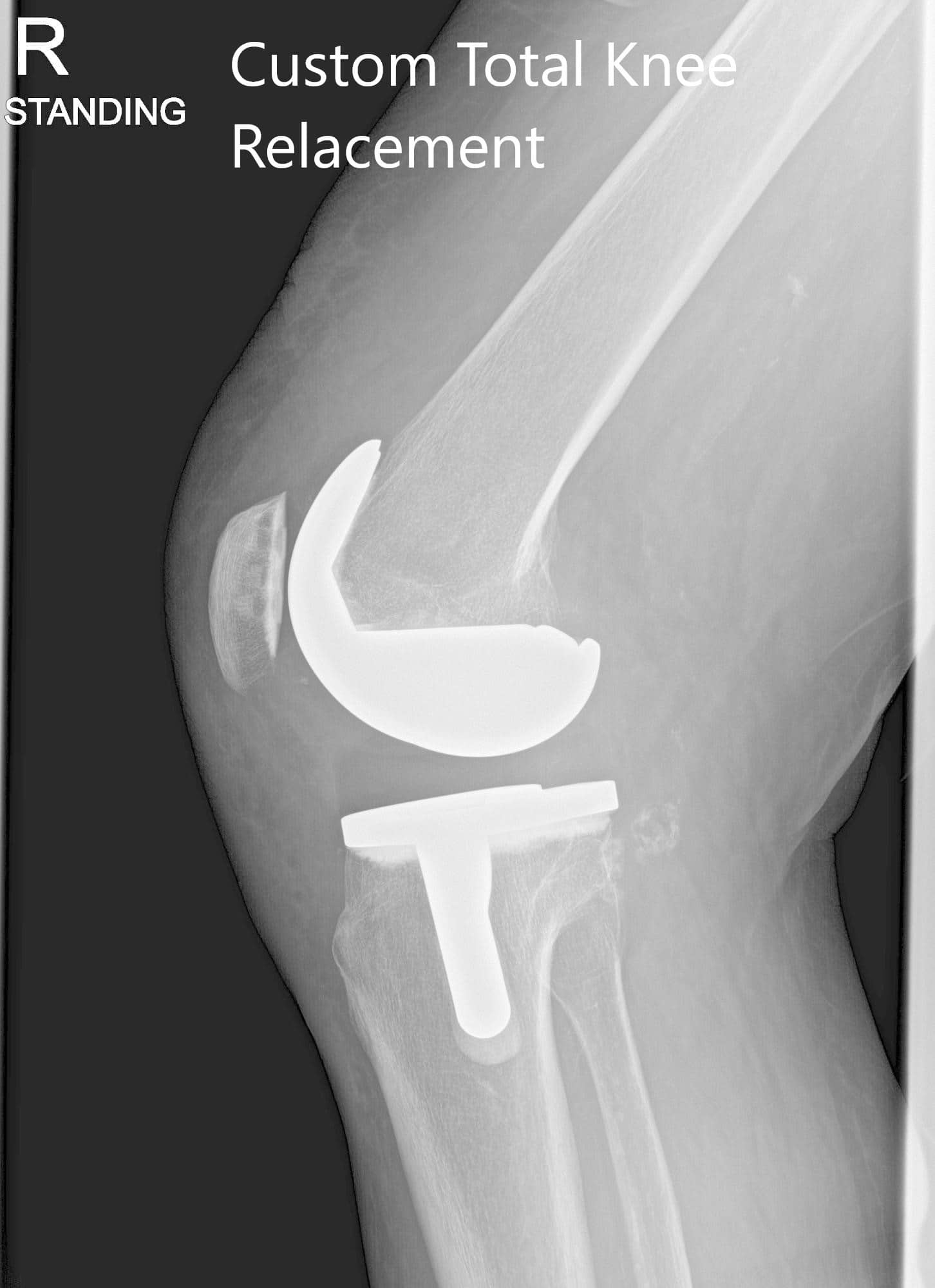Radiografía postoperatoria de la rodilla derecha del paciente mostrando penas astrales y vistas laterales - img 2