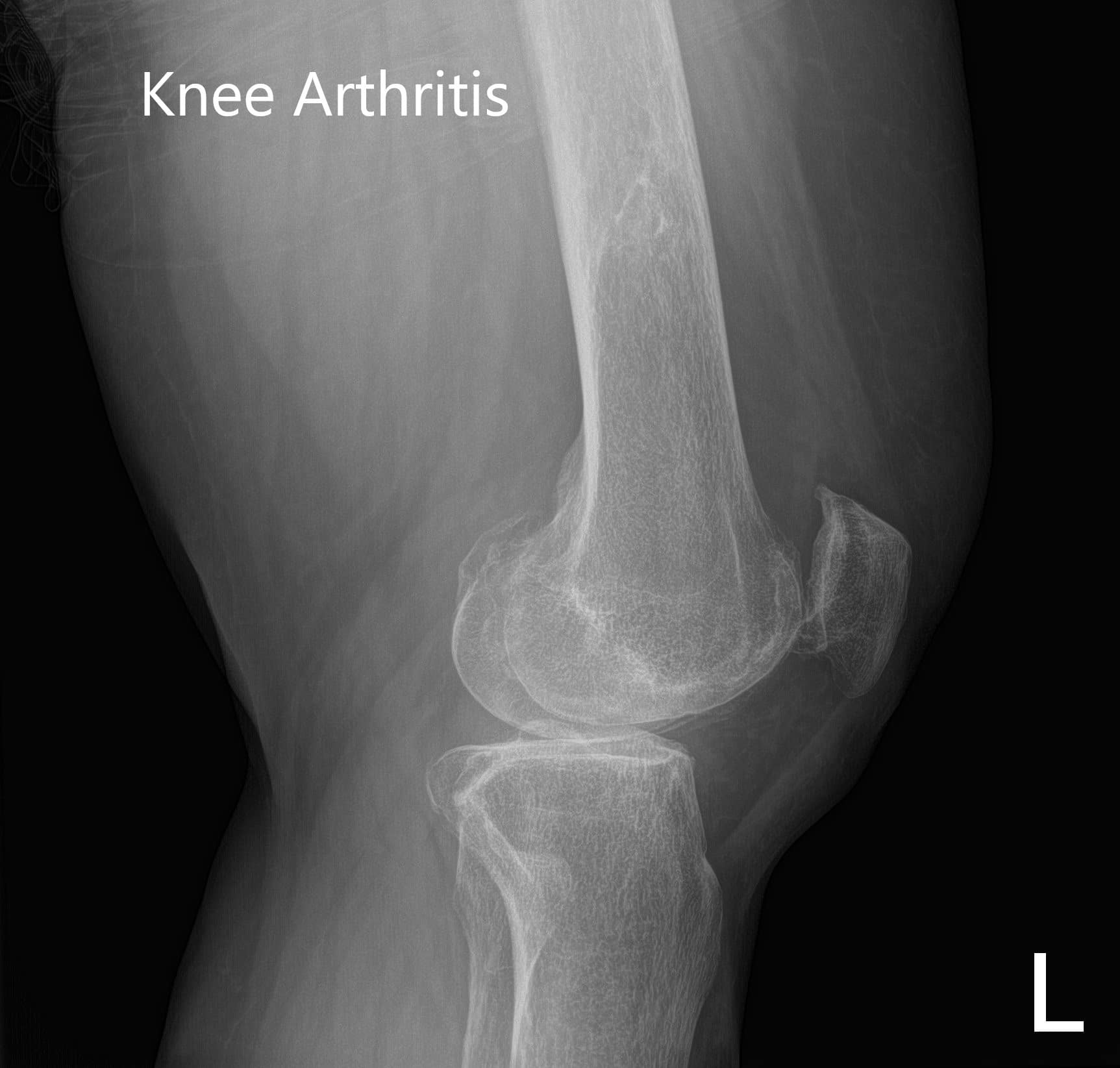 Radiografía preoperatoria que muestra imágenes AP e laterales de la rodilla izquierda - img 2