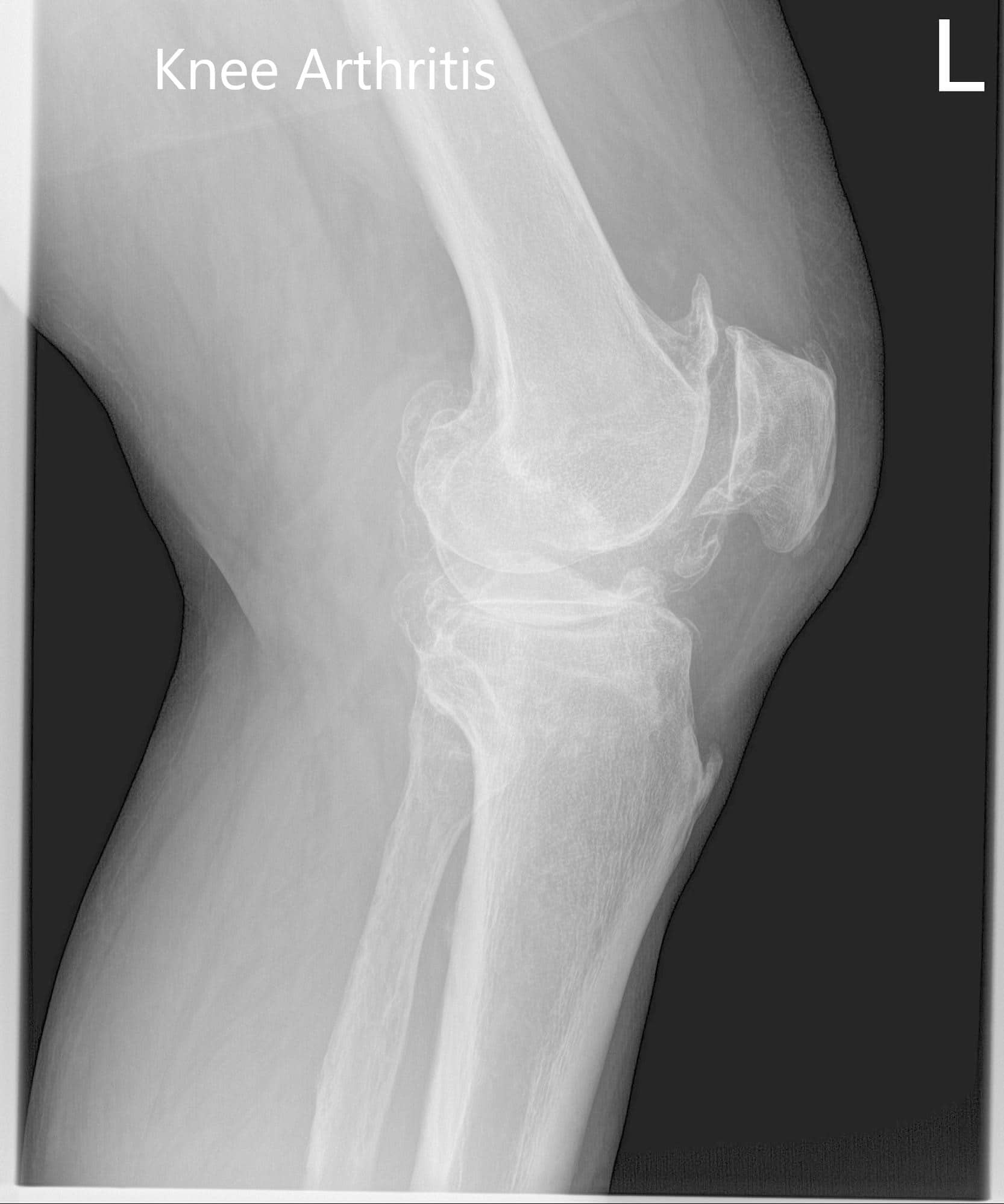 Radiografía preoperatoria de la rodilla izquierda mostrando visión AP y lateral de la rodilla con vista en el horizonte de la rótula - img 2