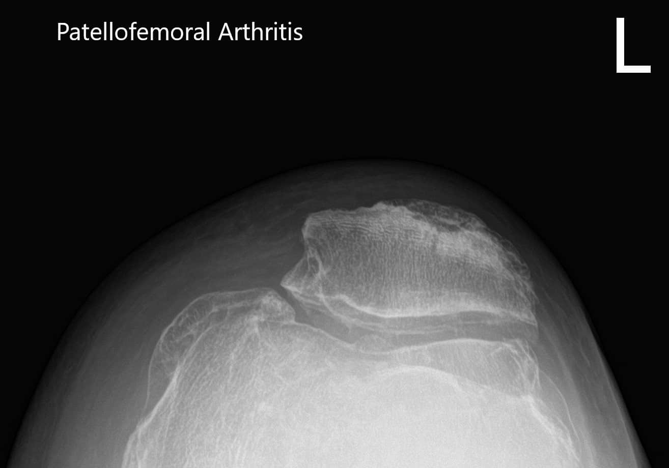 Radiografía preoperatoria de la rodilla izquierda que muestra visión AP y lateral de la rodilla con vista en el horizonte de la rótula - IMG 3