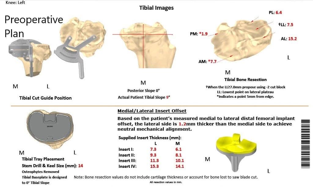 Plan quirúrgico completo de ortopedia específico para un reemplazo total de rodilla izquierda ustom en un hombre de 66 años