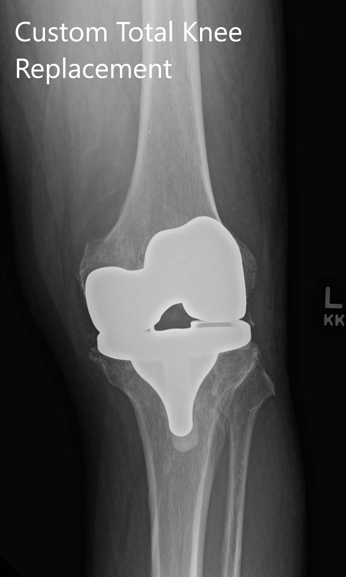 Radiografía postoperatoria que muestra imágenes AP e laterales de la rodilla izquierda