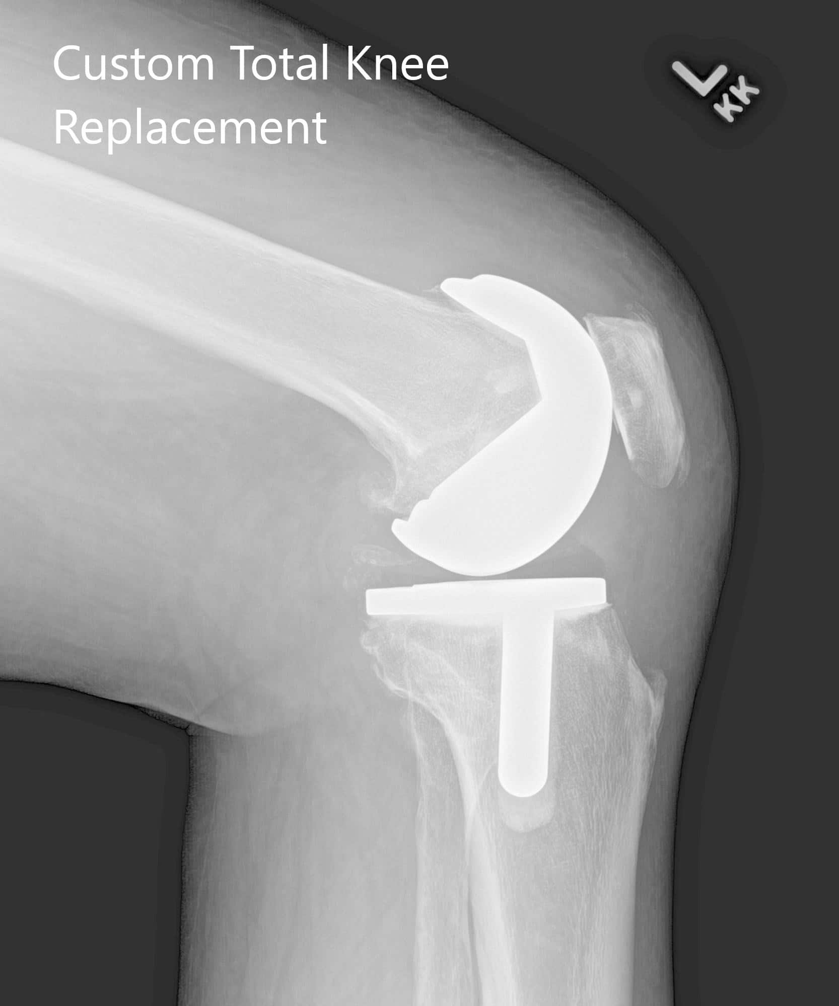 Radiografía postoperatoria que muestra imágenes AP e laterales de la rodilla izquierda - img 2
