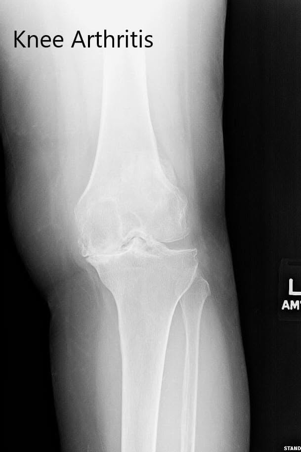 Preoperative X-ray of the left knee showing severe osteoarthritis in anteroposterior and lateral views Preoperative X-ray of the left knee showing severe osteoarthritis in anteroposterior and lateral views