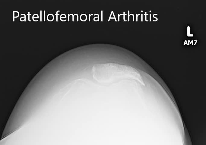 Preoperative X-ray showing the merchant view of the patella with severe patellofemoral arthritis Preoperative X-ray showing the merchant view of the patella with severe patellofemoral arthritis