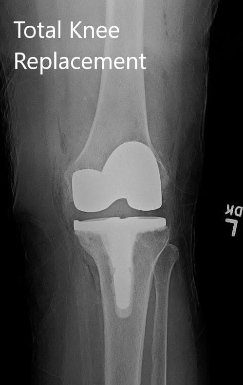 Postoperative X-ray showing the left knee joint with prosthesis in anteroposterior and lateral views Postoperative X-ray showing the left knee joint with prosthesis in anteroposterior and lateral views