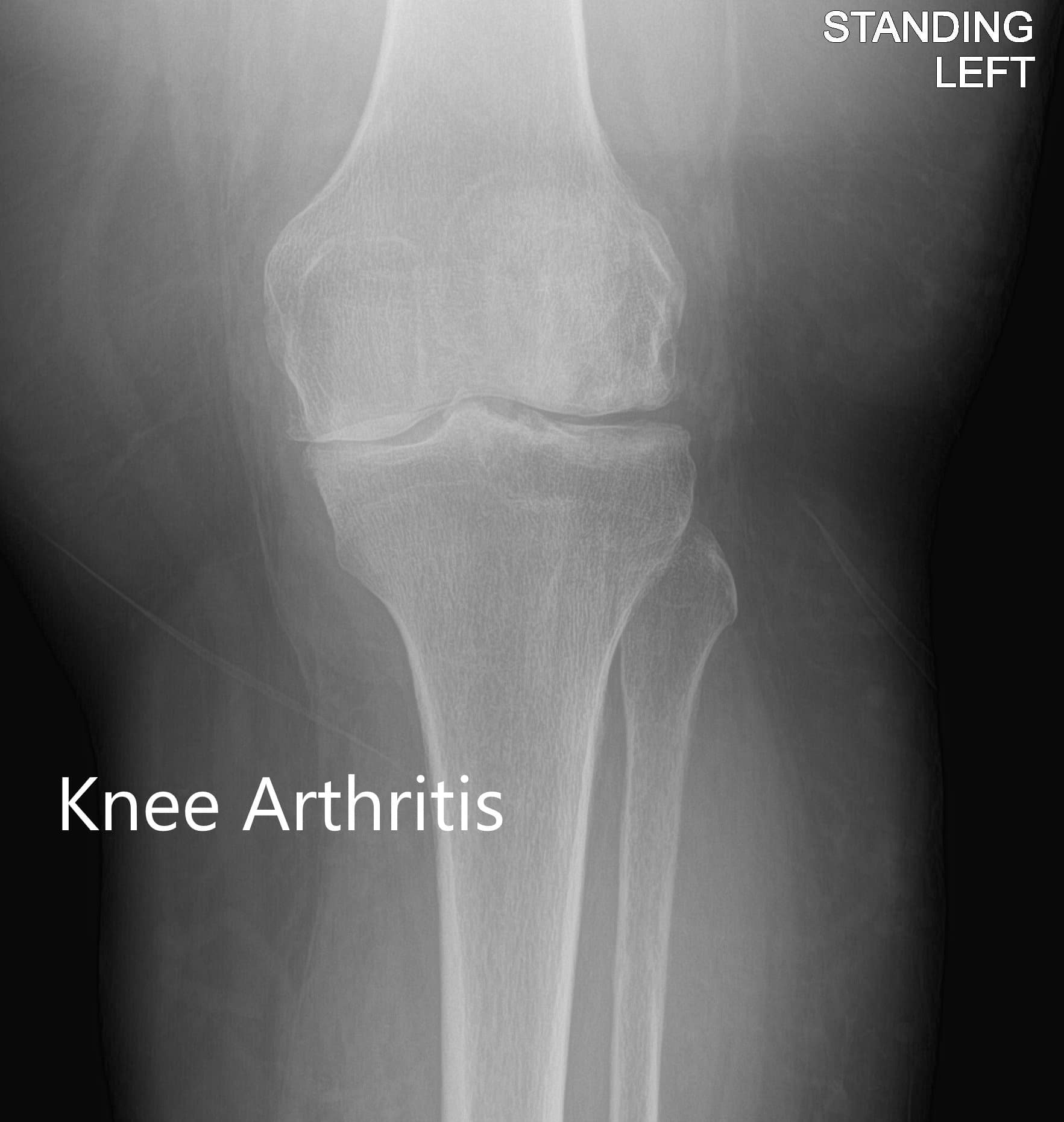 Vista anteroposterior y lateral de la rodilla izquierda Vista anteroposterior y lateral de la rodilla izquierda