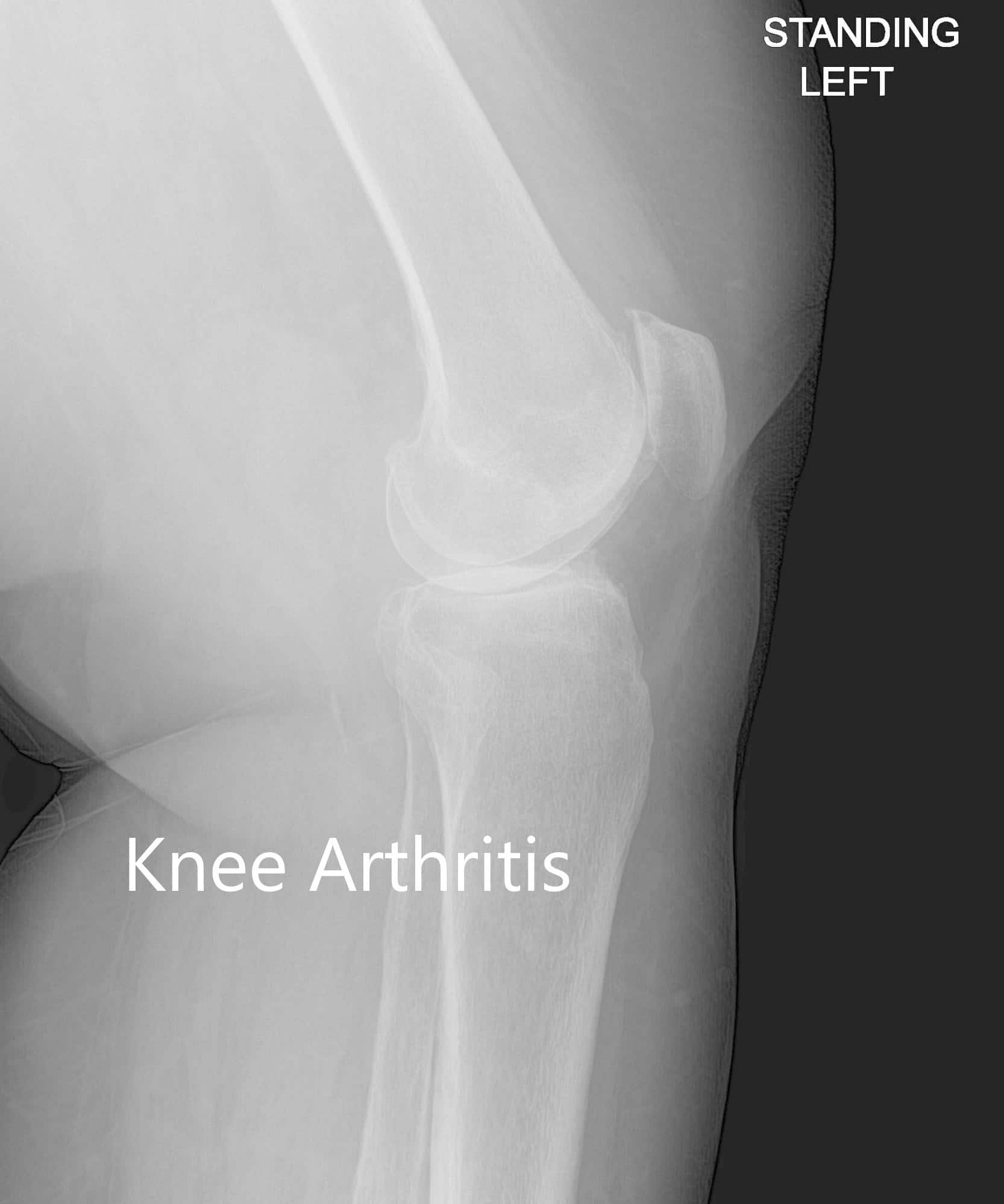Vista anteroposterior y lateral de la rodilla izquierda - img 2 Vista anteroposterior y lateral de la rodilla izquierda - img 2