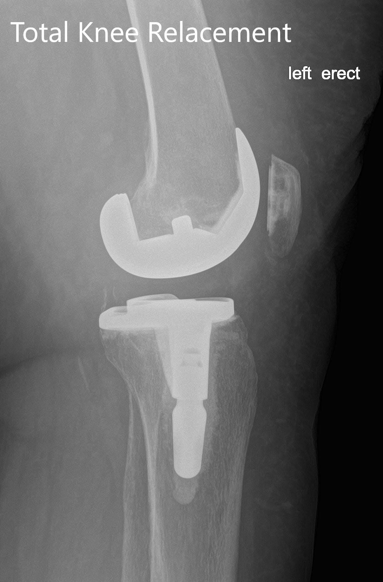 Radiografía postoperatoria de la izquierda mostrando la vista anteroposterior y lateral con prótesis total de rodilla en posición Radiografía postoperatoria de la izquierda mostrando la vista anteroposterior y lateral con prótesis total de rodilla en posición