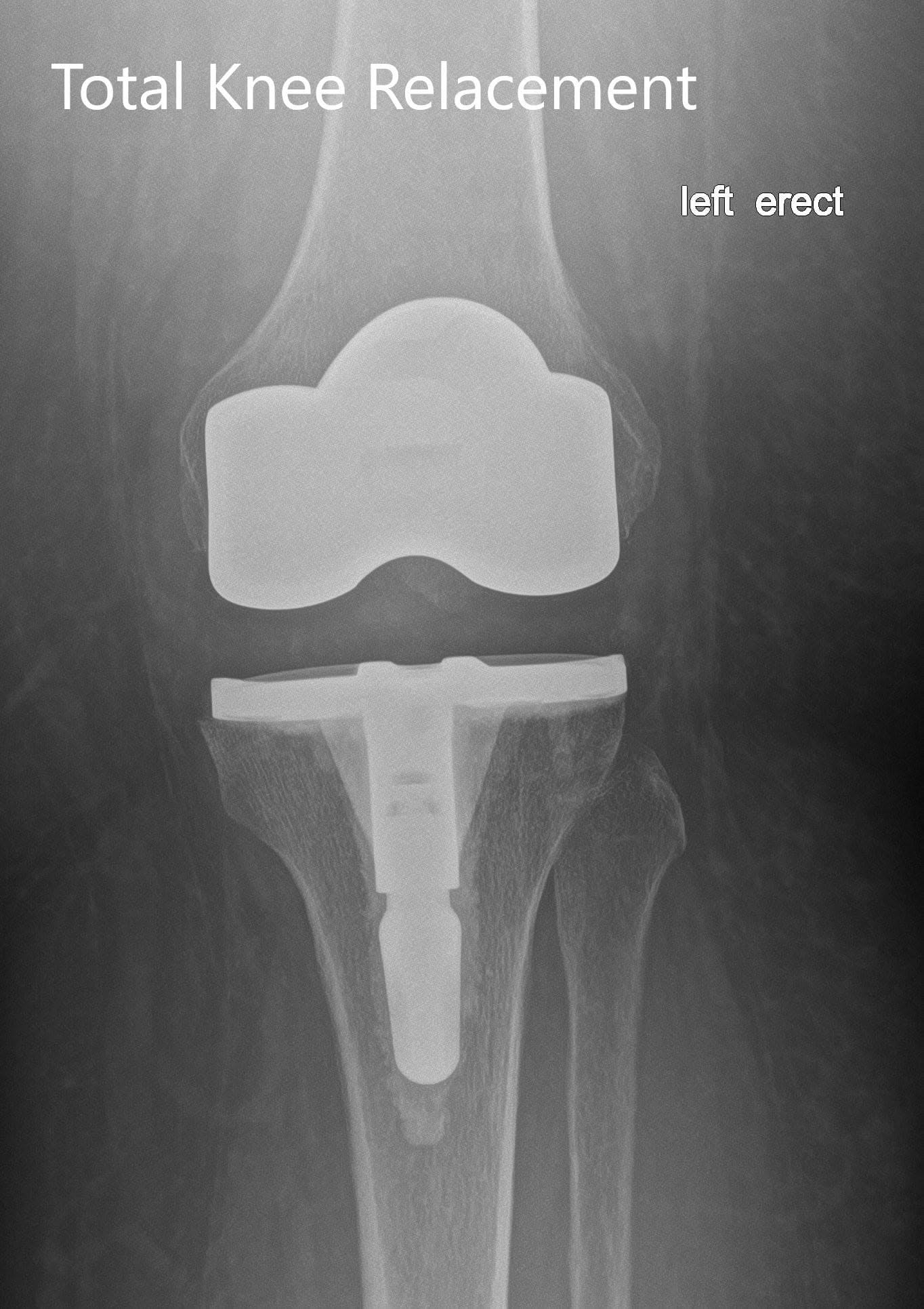 Radiografía postoperatoria de la izquierda mostrando la vista anteroposterior y lateral con prótesis total de rodilla en posición - img 2 Radiografía postoperatoria de la izquierda mostrando la vista anteroposterior y lateral con prótesis total de rodilla en posición - img 2