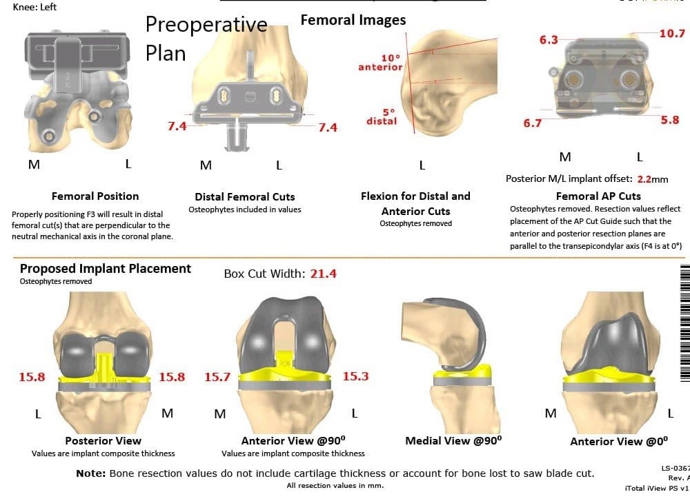 Plan quirúrgico completo específico para pacientes en ortopedia para un reemplazo total personalizado de rodilla en artritis de rodilla izquierda con hardware previo en la meseta tibial lateral - escaneo 2