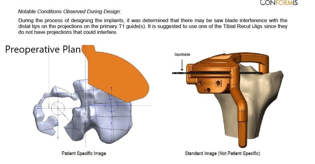 Plan quirúrgico completo específico para pacientes en ortopedia para un reemplazo total personalizado de rodilla en artritis de rodilla izquierda con hardware previo en la meseta tibial lateral - ecografía 4