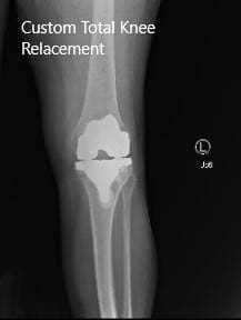 Imágenes de rayos X postoperatorias que muestran la vista AP y lateral