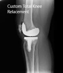 Post-Operative X-ray images showing AP and Lateral view - img 2