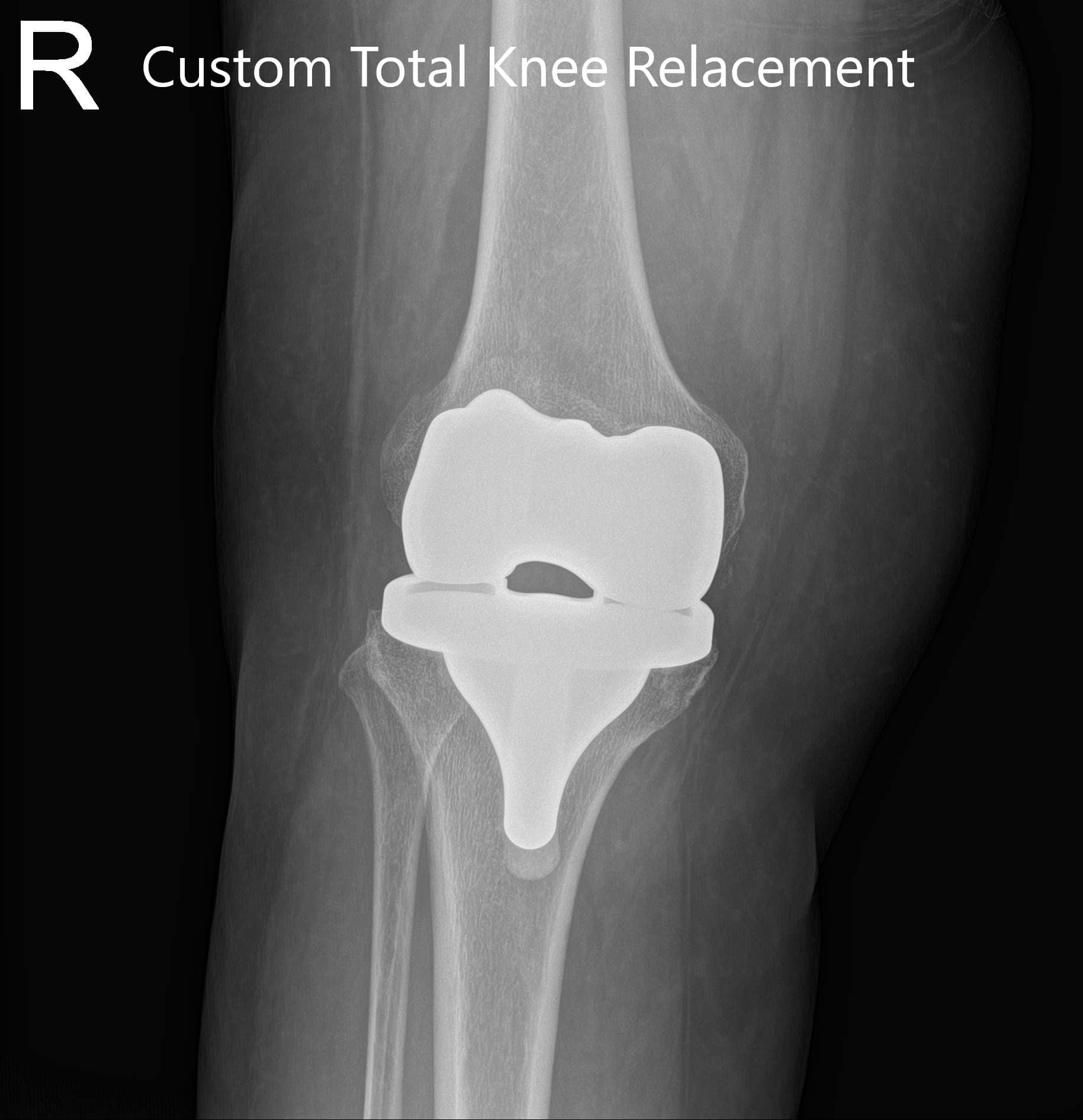 Postoperative X-ray of the right knee showing AP and lateral views