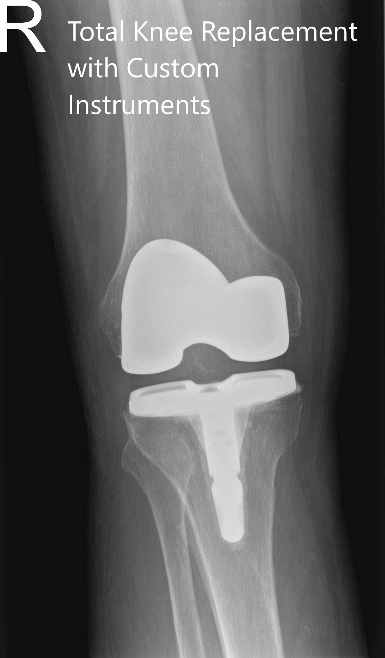 ostoperative X-ray of the right knee in anteroposterior and lateral views ostoperative X-ray of the right knee in anteroposterior and lateral views