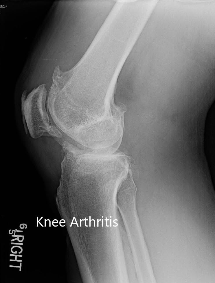 Preoperative X-ray of the right knee in lateral view and skyline view Preoperative X-ray of the right knee in lateral view and skyline view