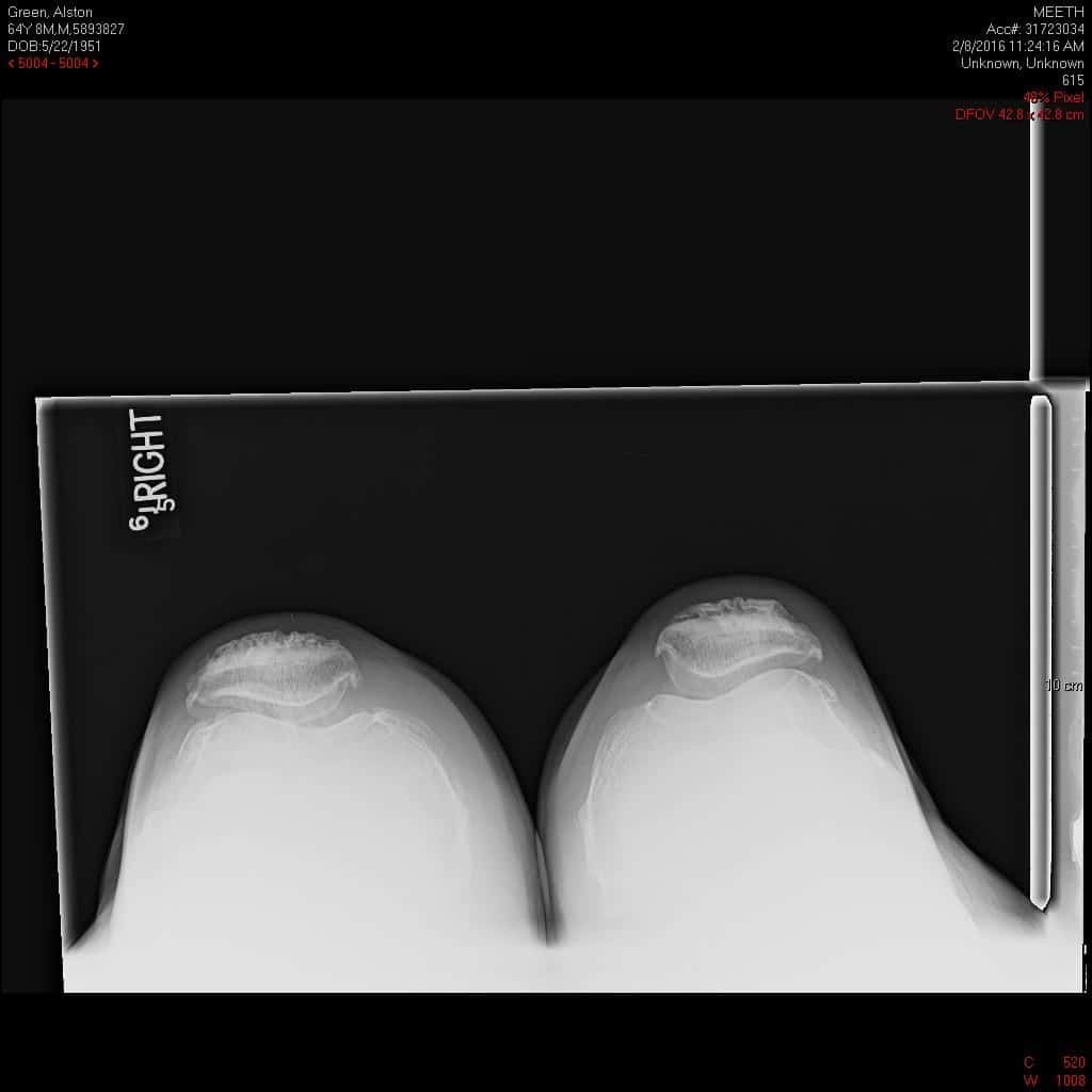 Preoperative X-ray of the right knee in lateral view and skyline view - img 2 Preoperative X-ray of the right knee in lateral view and skyline view - img 2