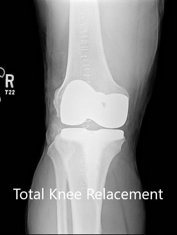 Postoperative X-ray of the right knee with a prosthesis in anteroposterior and lateral views Postoperative X-ray of the right knee with a prosthesis in anteroposterior and lateral views