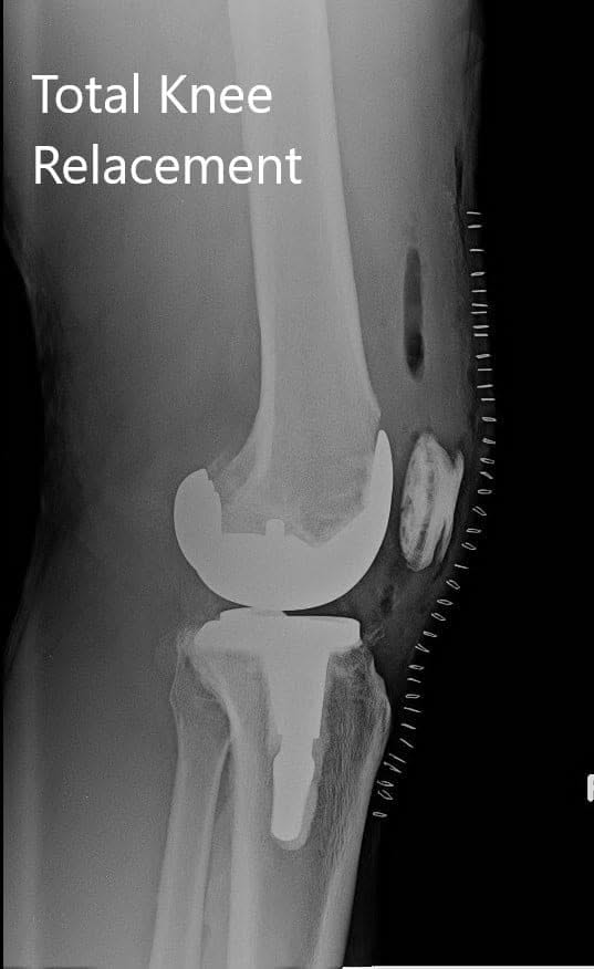 Postoperative X-ray of the right knee with a prosthesis in anteroposterior and lateral views - img 2 Postoperative X-ray of the right knee with a prosthesis in anteroposterior and lateral views - img 2