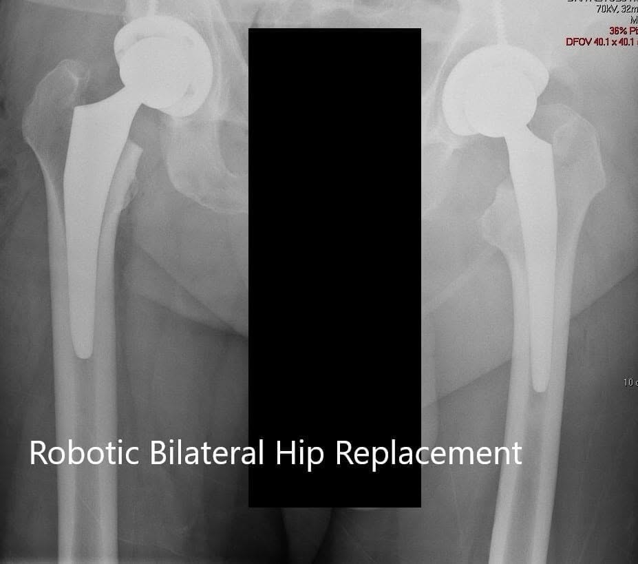 Postoperative X-ray of the patient’s pelvis with both hips Postoperative X-ray of the patient’s pelvis with both hips